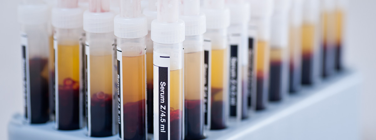 Postępowanie u chorych z małopłytkowością immunologiczną w starszym wieku
