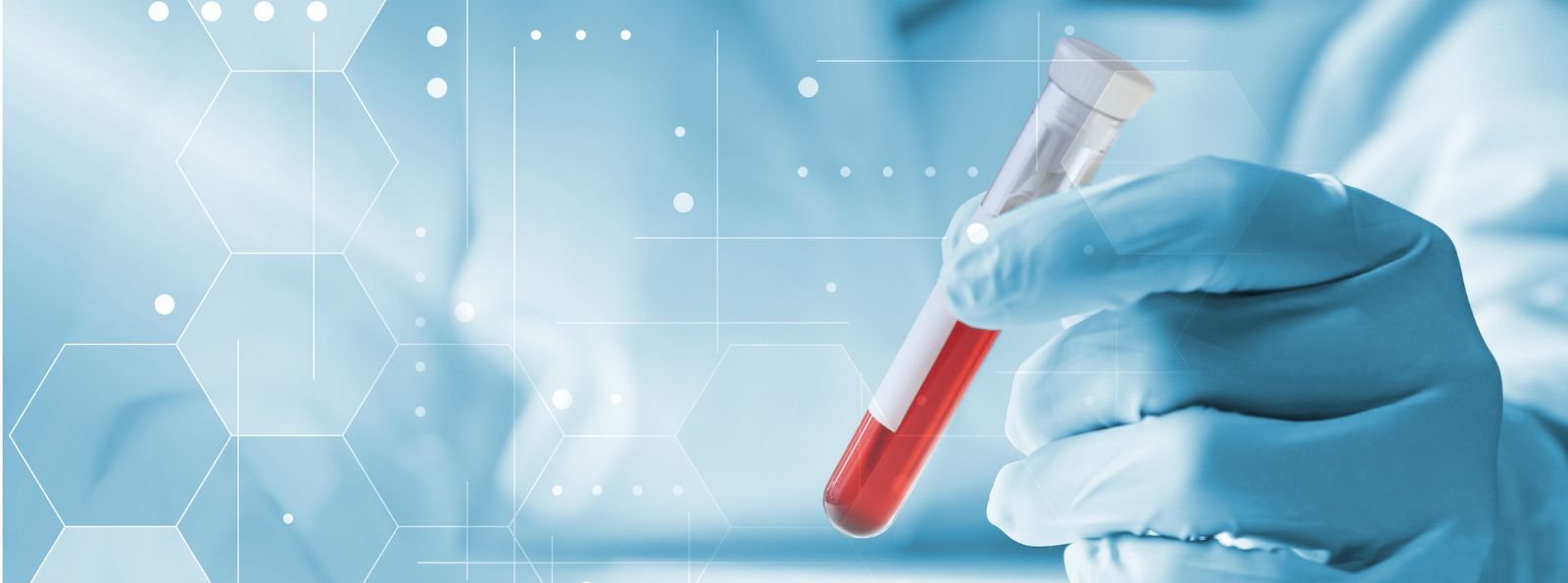 Bezpieczeństwo i skuteczność fitusiranu u chorych na hemofilie A i B – wyniki analizy pośredniej badania ATLAS-OLE