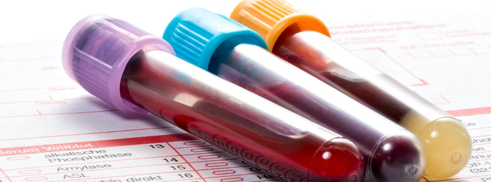 Hematolog: odkrycie nowego układu grup krwi potencjalnie pomocne w rzadkich powikłaniach hemolitycznych