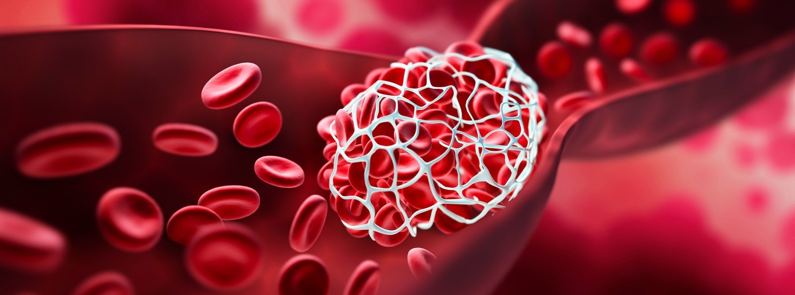 Brak odpowiedzi na leczenie u pacjentów z nocną napadową hemoglobinurią – komentarz panelu ekspertów z regionu CEE