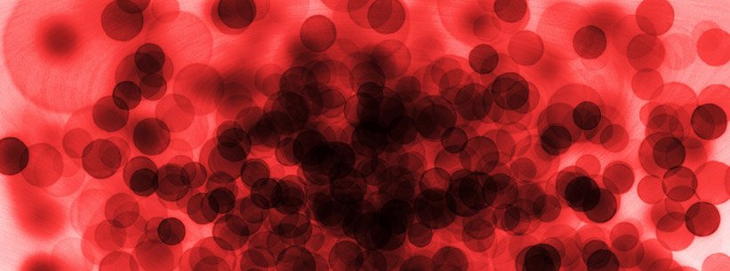 Małopłytkowość u chorych na zespoły mielodysplastyczne - wciąż nierozwiązany problem