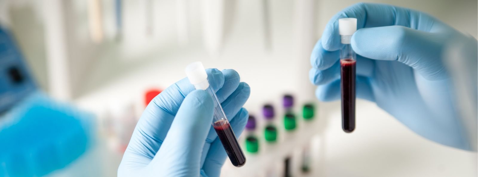 Przyszłość terapii marstacimabem: personalizacja leczenia i perspektywa przejścia z emicizumabu