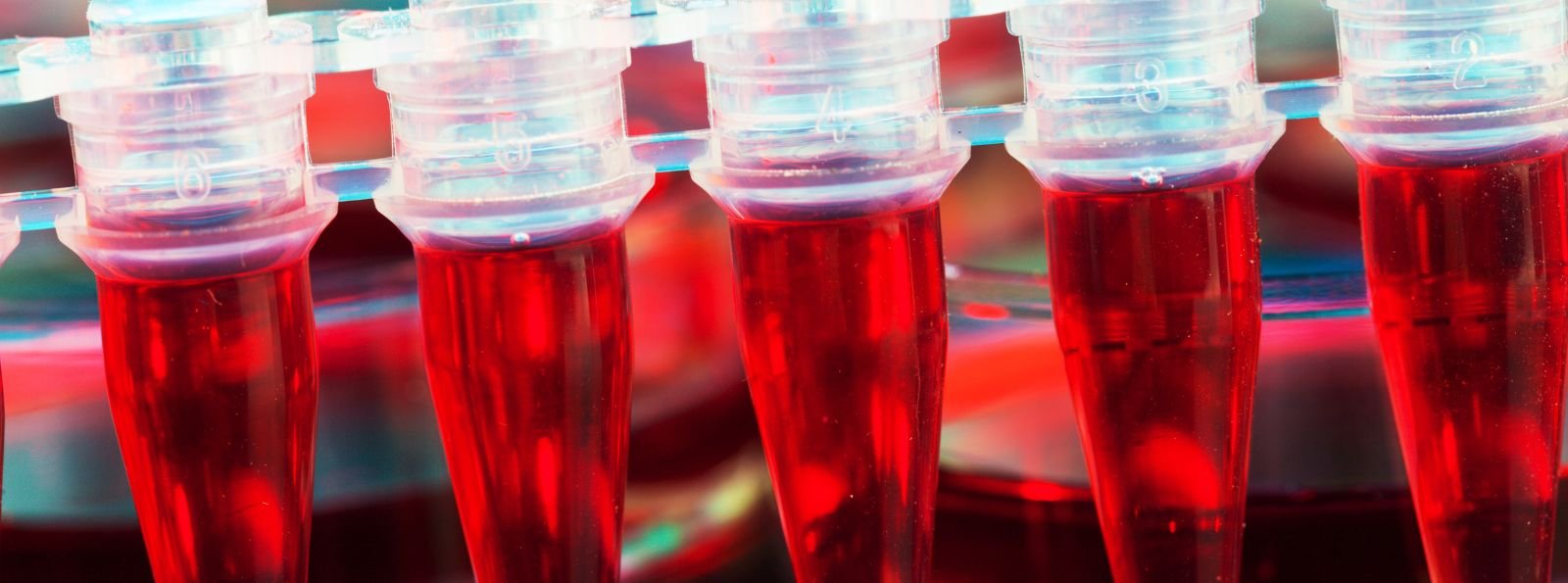 Skuteczność i bezpieczeństwo emicizumabu u pacjentów z ciężką hemofilią A bez inhibitora. Raport z 3-letniej obserwacji Brytyjskiej Organizacji Lekarzy Leczących Chorych na Hemofilię (UKHCDO)