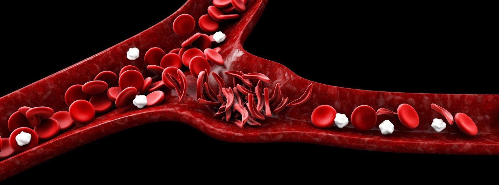 Apiksaban a ryzyko nawrotu udaru mózgu u pacjentów z dysfunkcją lewej komory. Wtórna analiza badania ARCADIA