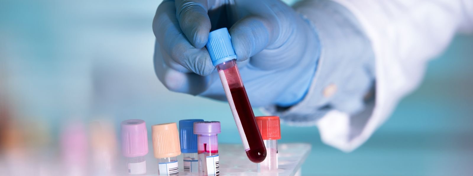 Przegląd doniesień z konferencji EAHAD 2026 dotyczących stosowania emicizumabu (Hemlibra®) u pacjentów z hemofilią A