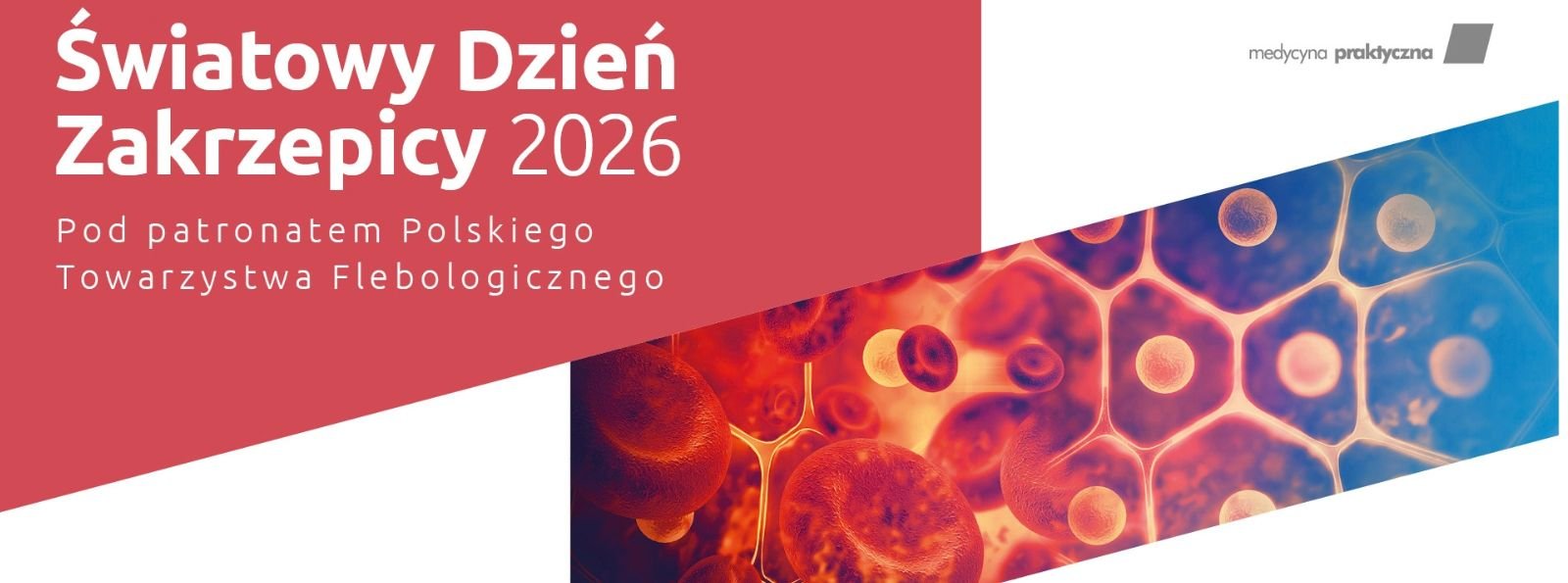 Światowy Dzień Zakrzepicy 2026: jak podejmować decyzje diagnostyczne i terapeutyczne?