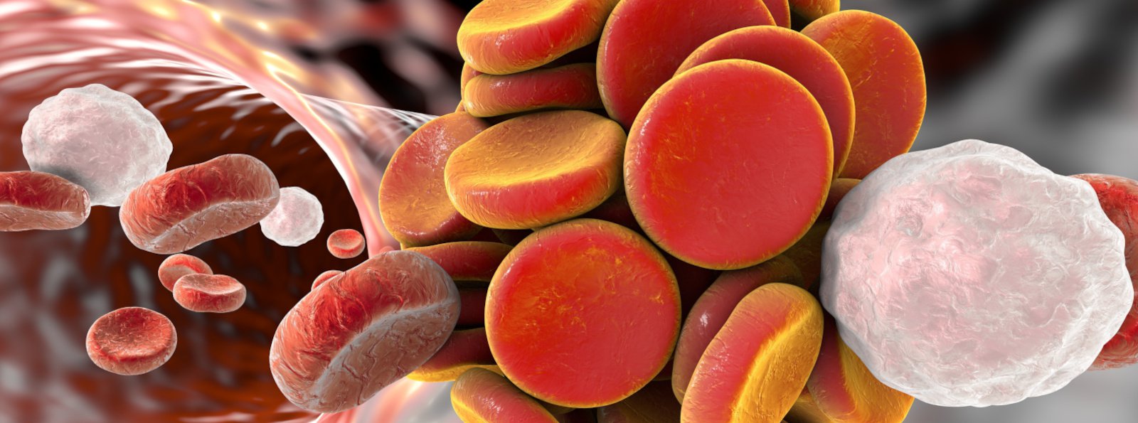 Zakrzepica tętnicza (arterial thromboembolism = ATE) u chorych na żylną chorobę zakrzepowo-zatorową